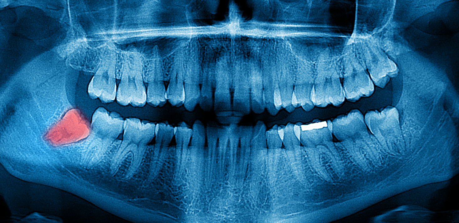Ортопантомограмма челюсти