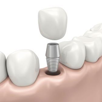 Имплантация зуба после костной пластики  – стоматология 21 Век, Краснодар