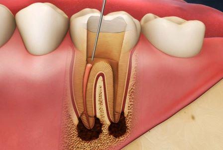 Симптомы воспаления корня зуба